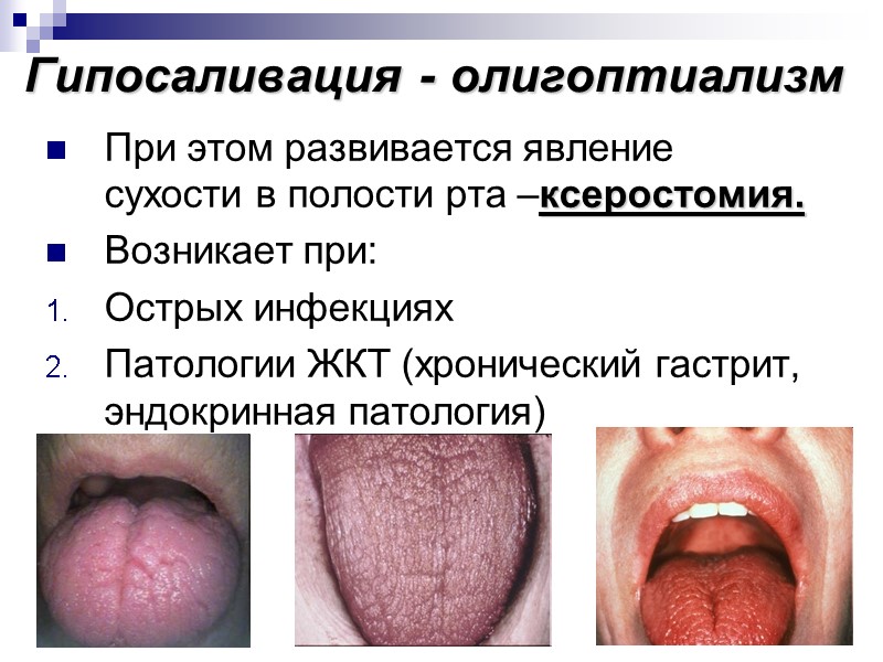 Гипосаливация - олигоптиализм При этом развивается явление сухости в полости рта –ксеростомия. Возникает при: